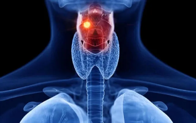 Ung thư thanh quản giai đoạn 2 (Nguồn: Internet)