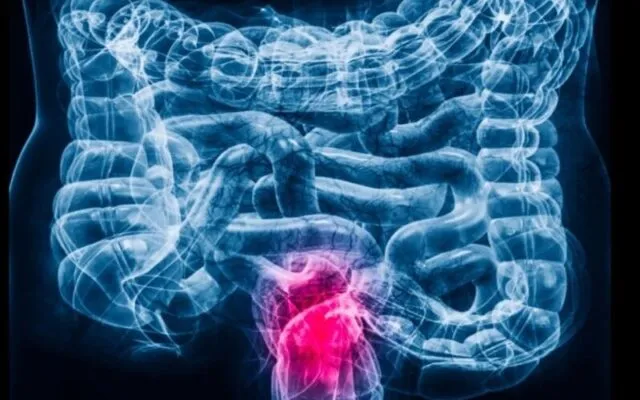 Ung thư trực tràng giai đoạn đầu (Nguồn: Internet)