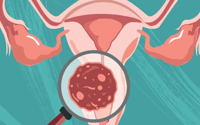 Ung thư tử cung giai đoạn 3 (Nguồn: Internet)