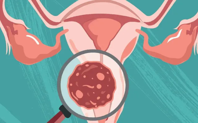 Ung thư tử cung giai đoạn 3 (Nguồn: Internet)