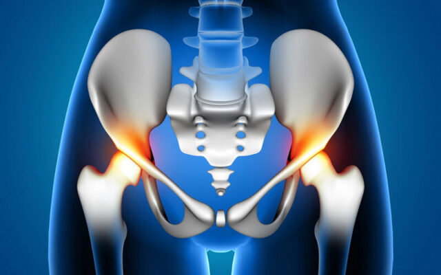 Viêm khớp háng (Nguồn: Internet)
