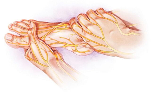 Viêm thần kinh ngoại biên (Nguồn: Internet)