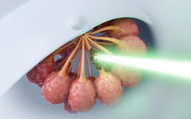 Xạ trị ung thư vú (Nguồn: Internet)