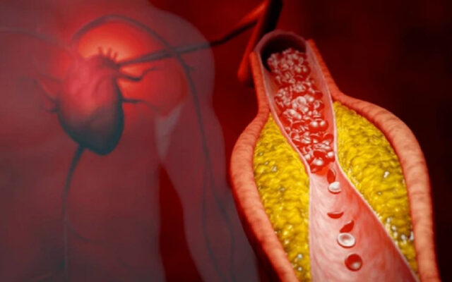 Xơ vữa động mạch vành (Nguồn: Internet)