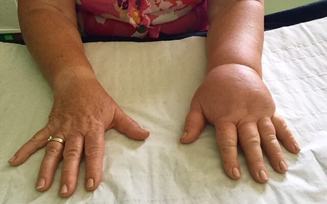 Bệnh phù bạch huyết (Nguồn: Internet)