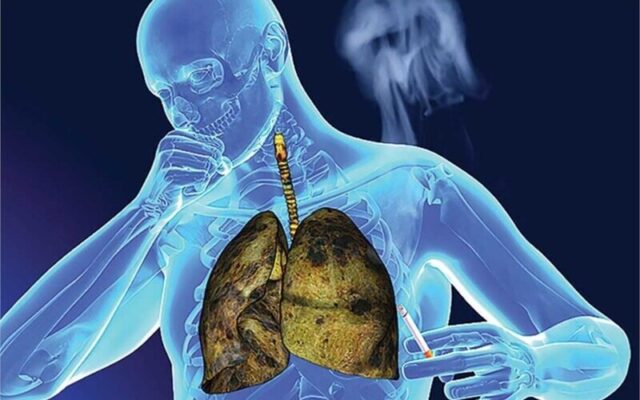 Chọn bệnh viện điều trị ung thư phổi tốt nhất TP.HCM để nâng cao tỷ lệ chữa khỏi (Nguồn: Internet)