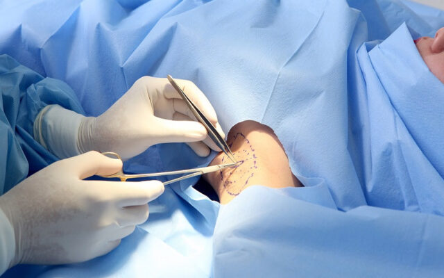 Quy trình phẫu thuật cắt hạch nách (Nguồn: Internet)