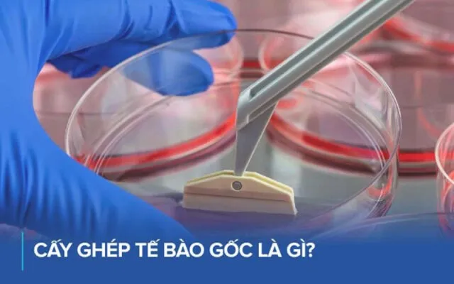 Cấy ghép tế bào gốc là gì? (Nguồn: Internet)