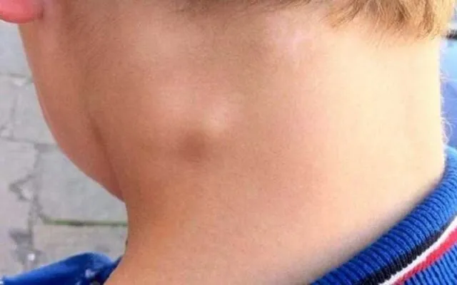 Hạch cổ (Nguồn: Internet)