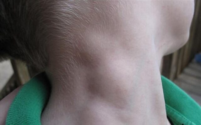 Cổ có nhiều hạch (Nguồn: Internet)