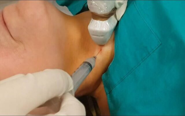 FNA hạch cổ (Nguồn: Internet)