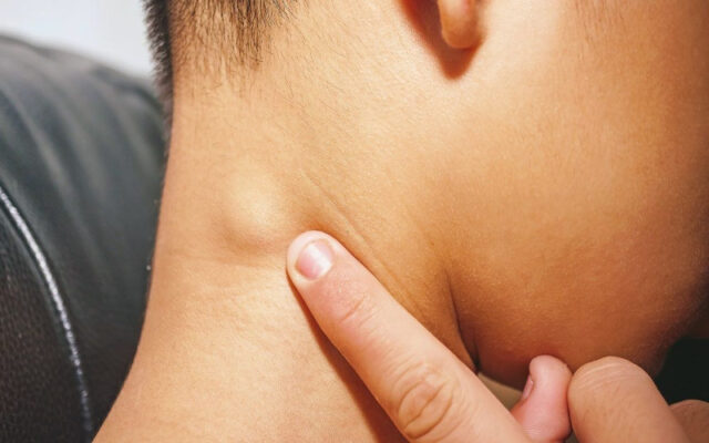 Hạch nhảy là gì? (Nguồn: Internet)