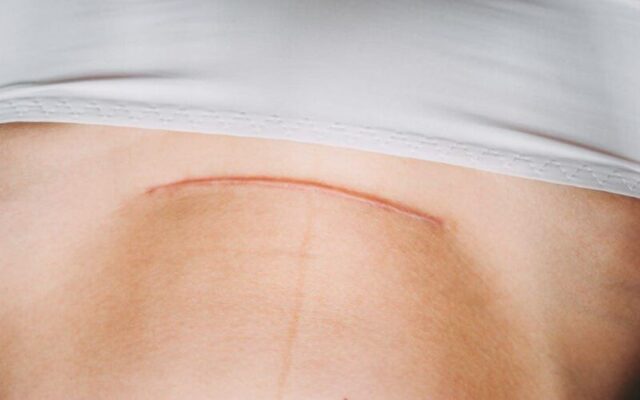 Vết mổ (Nguồn: Internet)