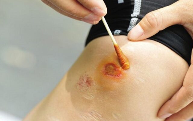 Làm sao để vết thương hở mau lành? (Nguồn: Internet)