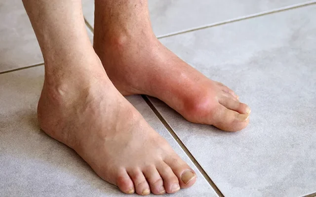 Bệnh gút (Nguồn: Internet)