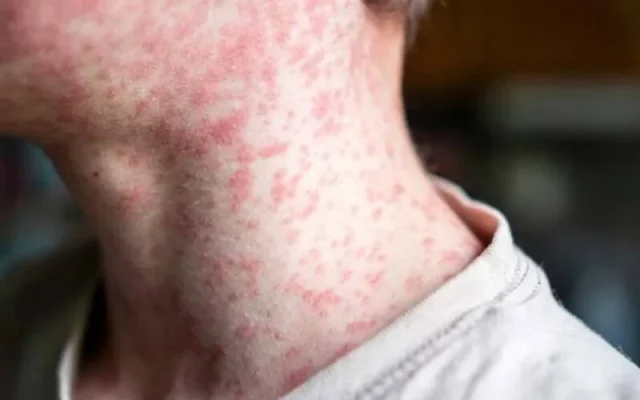 Bệnh sởi (Nguồn: Internet)