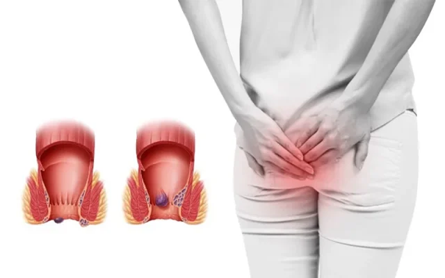 Bệnh trĩ là gì? (Nguồn: Internet)