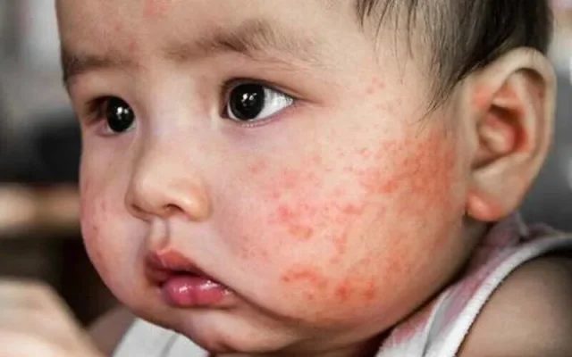 Chàm sữa (Nguồn: Internet)