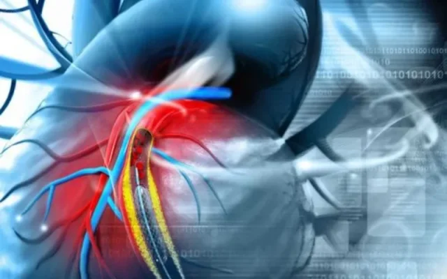 Có thể đặt bao nhiêu stent trong cơ thể? (Nguồn: Internet)