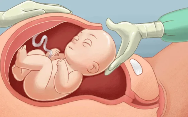 Mổ đẻ (Nguồn: Internet)