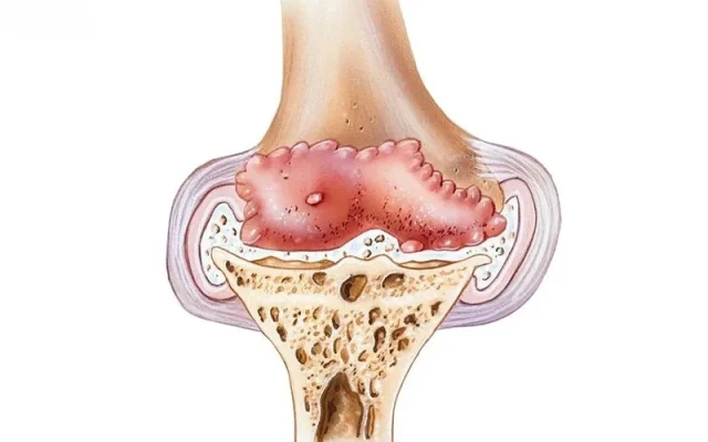 Gai khớp gối là gì? (Nguồn: Internet)