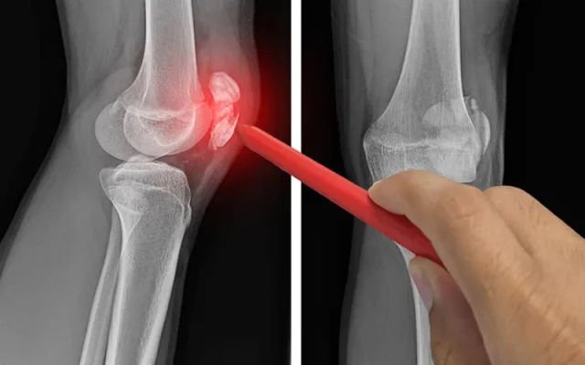 Giãn dây chằng (Nguồn: Internet)