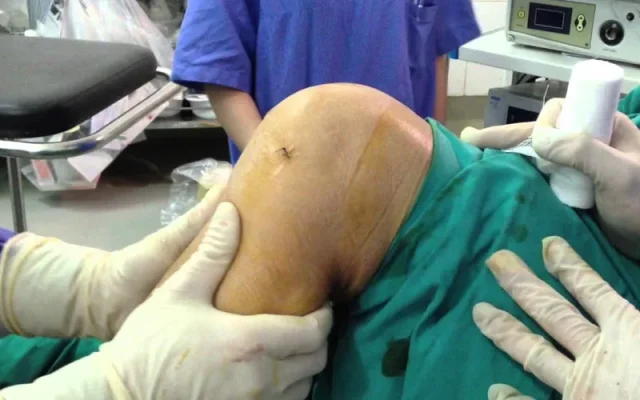 Giãn dây chằng có phải mổ không (Nguồn: Internet)