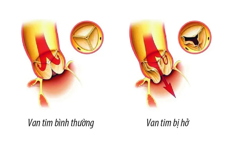Hở van tim (Nguồn: Internet)