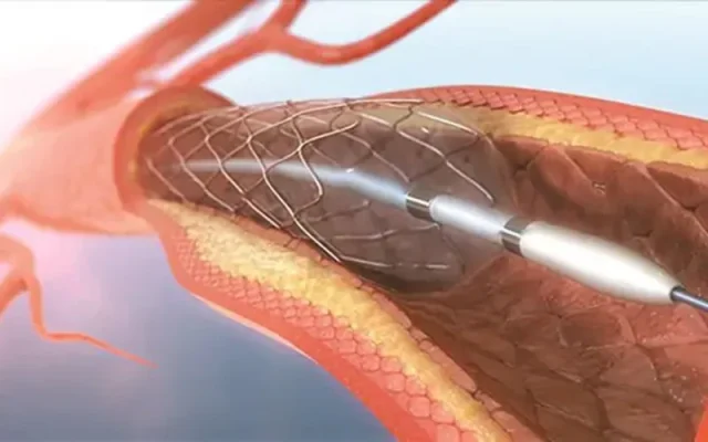 Đặt stent mạch vành là gì? (Nguồn: Internet)