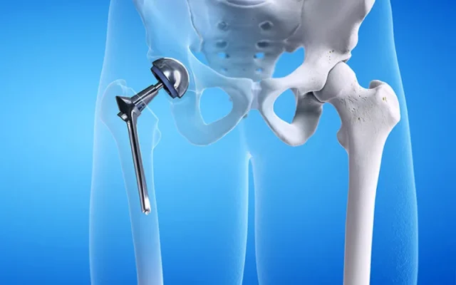 Thay khớp háng (Nguồn: Internet)