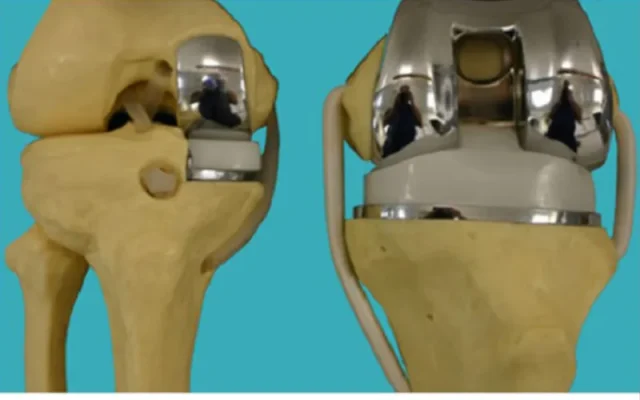 Khi nào phải thay khớp gối (Nguồn: Internet)