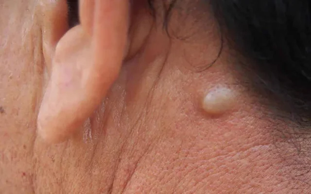 Lao hạch nếu không điều trị có thể gây biến dạng vùng cổ, ảnh hưởng chức năng (Nguồn: Internet)