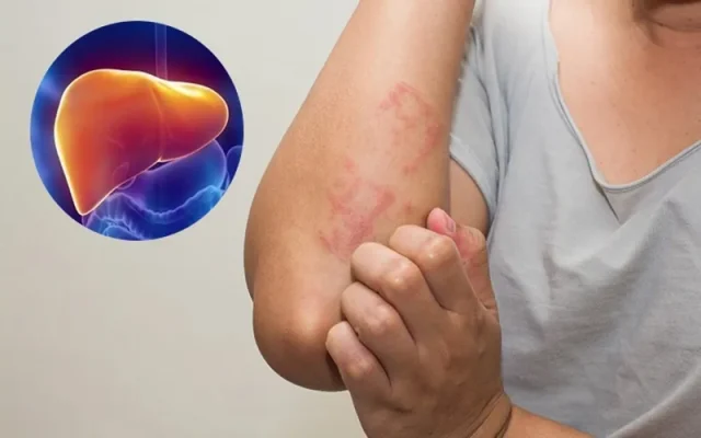 Làm sao biết gan bị nhiễm độc thông qua dấu hiệu (Nguồn: Internet)