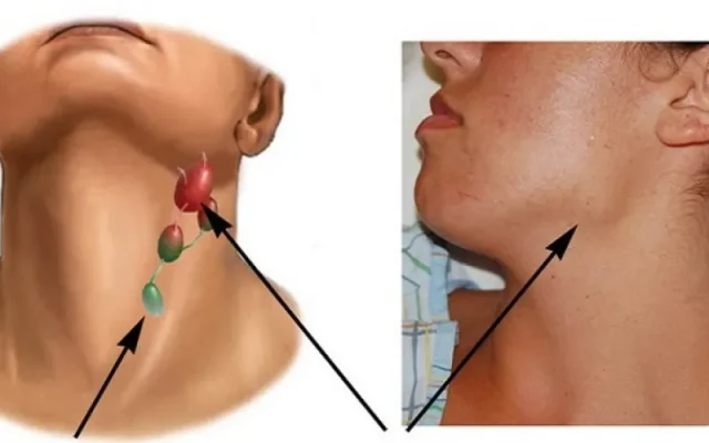 Hạch do ung thư (Nguồn: Internet)