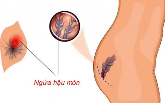 Ngứa hậu môn là gì? (Nguồn: Internet)