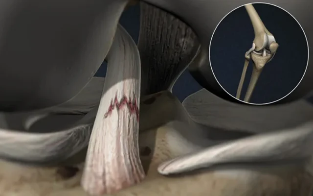 Rách dây chằng (Nguồn: Internet)