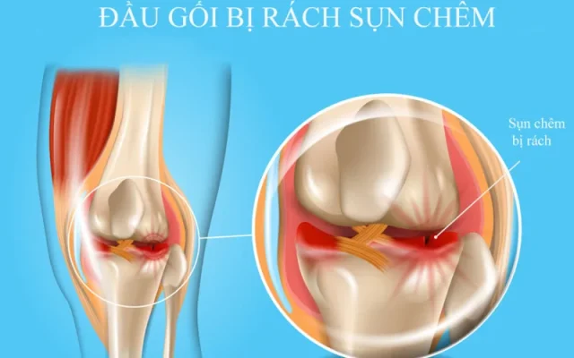 Rách sụn chêm (Nguồn: Internet)