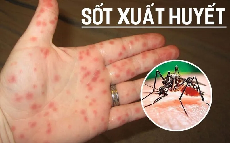 Sốt xuất huyết (Nguồn: Internet)