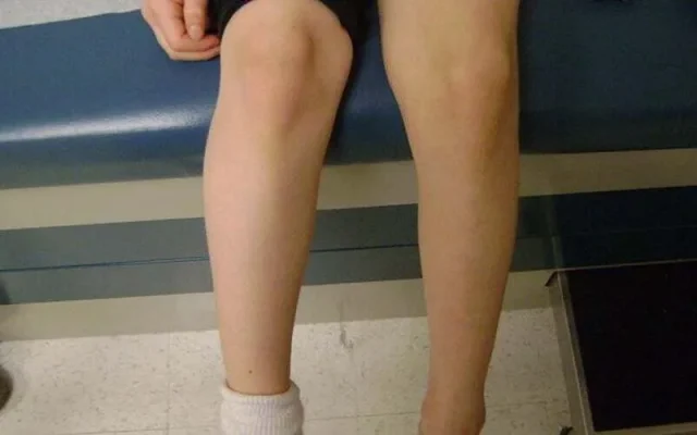 Tại sao đứt dây chằng lại teo cơ (Nguồn: Internet)