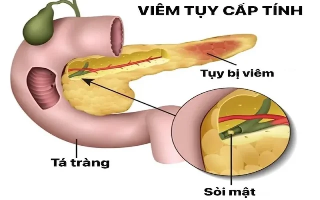 Viêm tụy cấp là gì? (Nguồn: Internet)