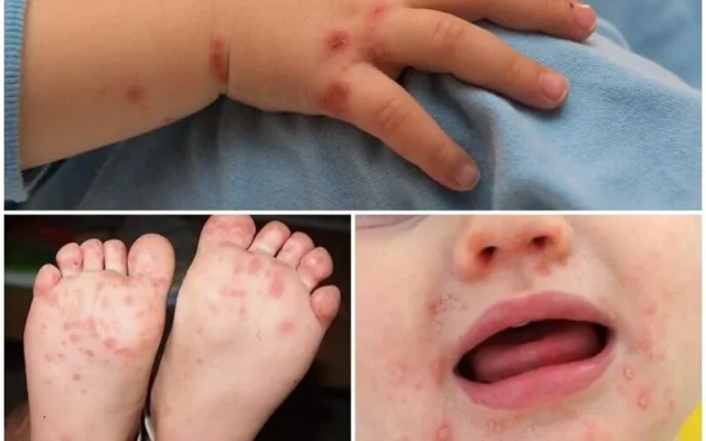 Bệnh tay chân miệng (Nguồn: Internet)