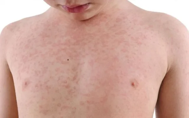 Trẻ em bị sởi phải làm sao để giảm triệu chứng? (Nguồn: Internet)