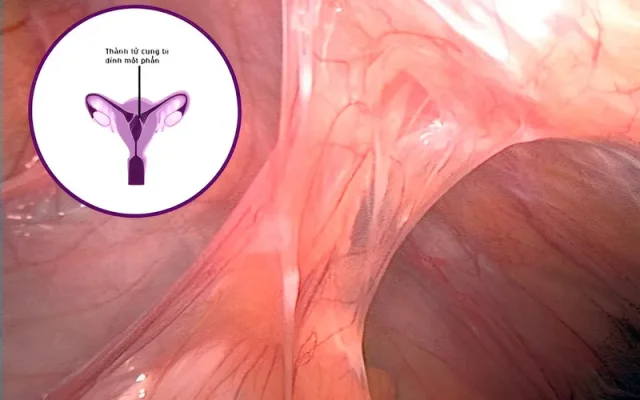 Tử cung dính thành bụng (Nguồn: Internet)