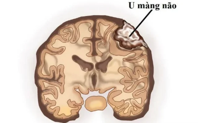 U màng não (Nguồn: Internet)