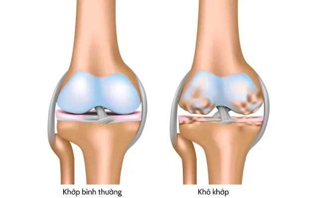 Khô khớp là gì? (Nguồn: Internet)