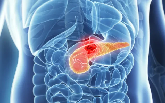 Viêm tụy là gì? Viêm tụy có nguy hiểm không? (Nguồn: Internet)