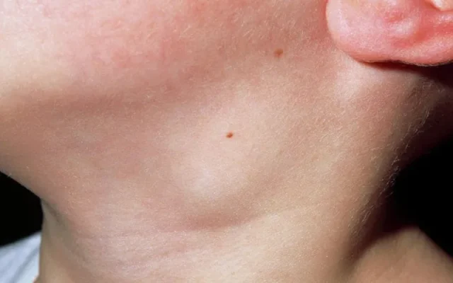 Bị hạch có phải mổ không? (Nguồn: Internet)