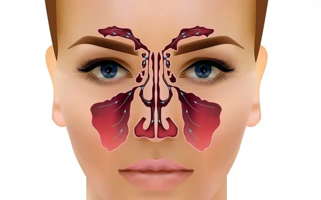 Phân loại viêm xoang theo thời gian (Nguồn: Internet)