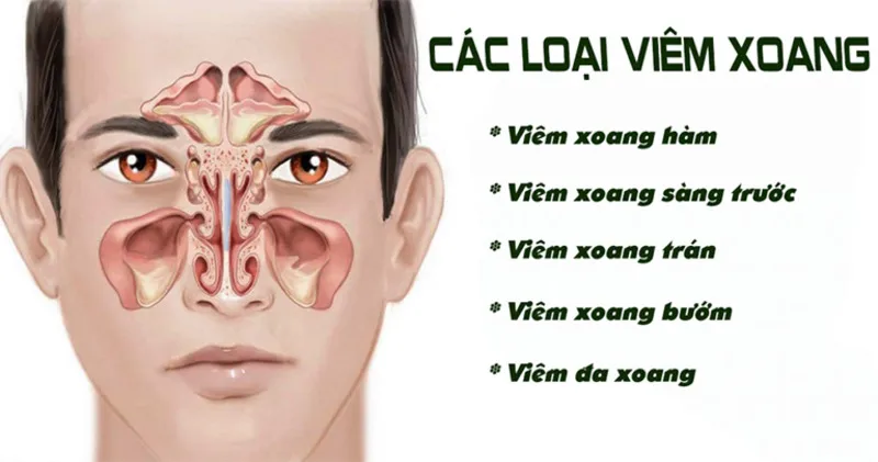 Phân loại viêm xoang theo vị trí xoang bị viêm (Nguồn: Internet)