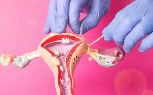 Các phương pháp thắt ống dẫn trứng phổ biến (Nguồn: Internet)